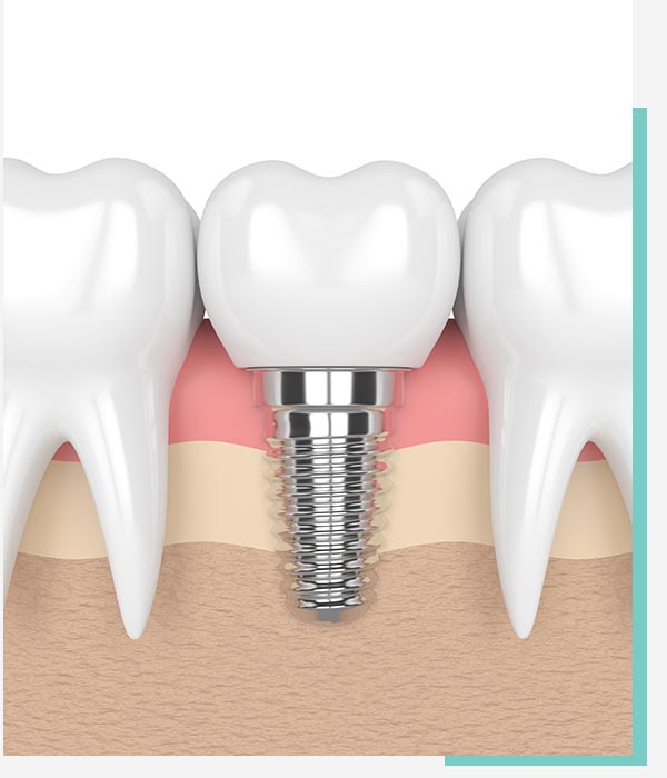 dental-implant-procedure-kellyville