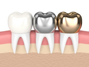 dental crowns kellyville