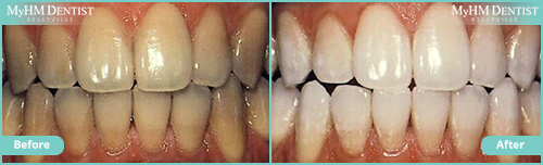 Teeth whitening case 2 in Kellyville