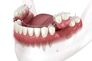 cost of dentures for elderly kellyville