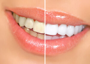 
teeth whitening benefits kellyville