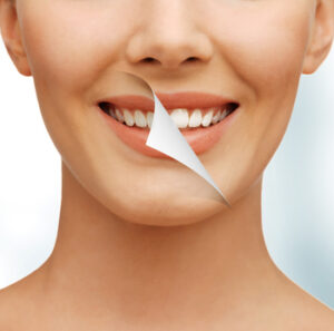 teeth whitening procedure kellyville