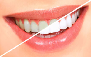 whitening teeth treating kellyville