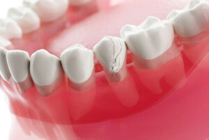 Veneers For Crooked Teeth front teeth kellyville
